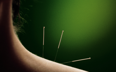 Difference-between-dry-needling-and-acupuncture