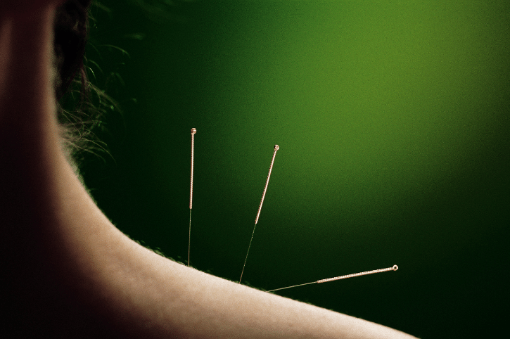 Difference-between-dry-needling-and-acupuncture